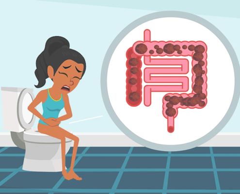 INTESTINO IRRITABILE